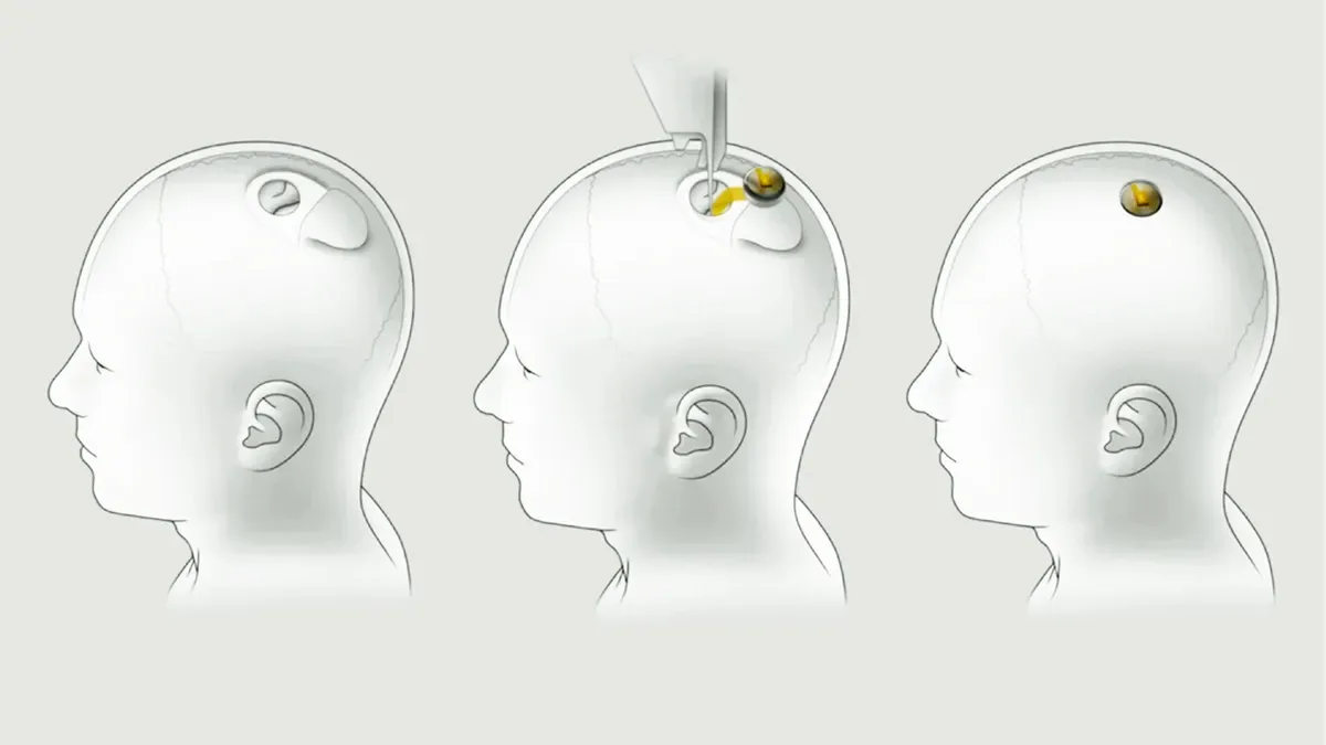 İnsan deneylerine başlayan Neuralink, 43 milyon dolar daha yatırım aldı